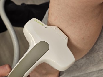 Intense Pulsed Light Hair Removal