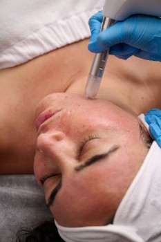 Ottawa Microneedling Clinic