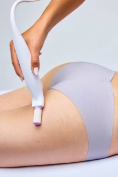 Stretch Marks Removal Ottawa