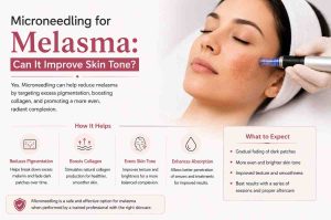 Microneedling for Melasma: Can It Improve Skin Tone?