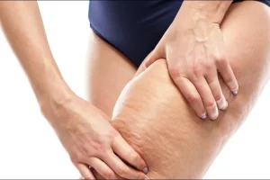 cellulite-reduction-thigh-treatment-sazan-beauty-ottawa-1024x536